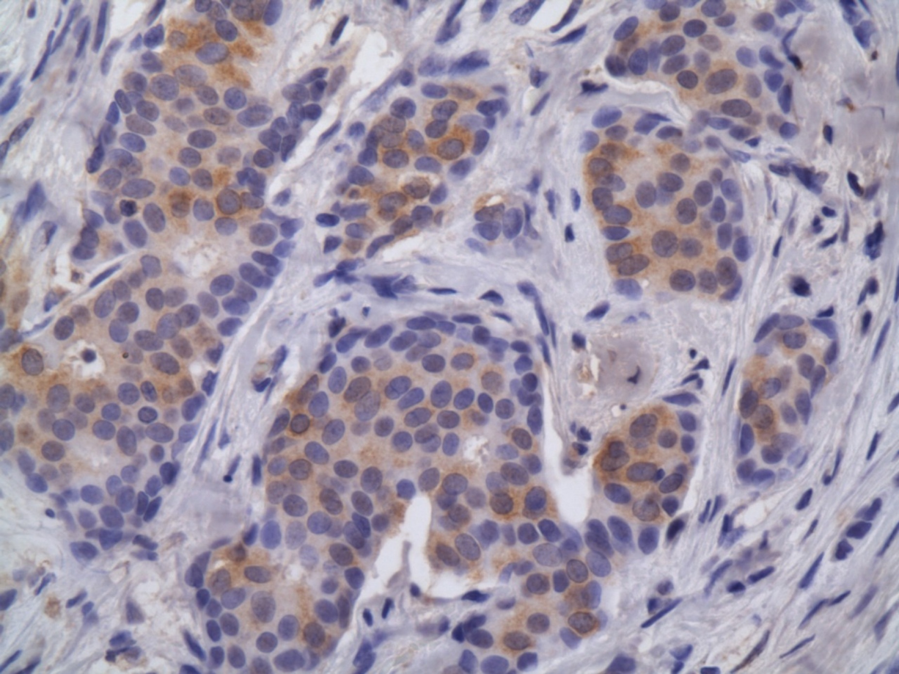 Microscope image of cancer cells. 