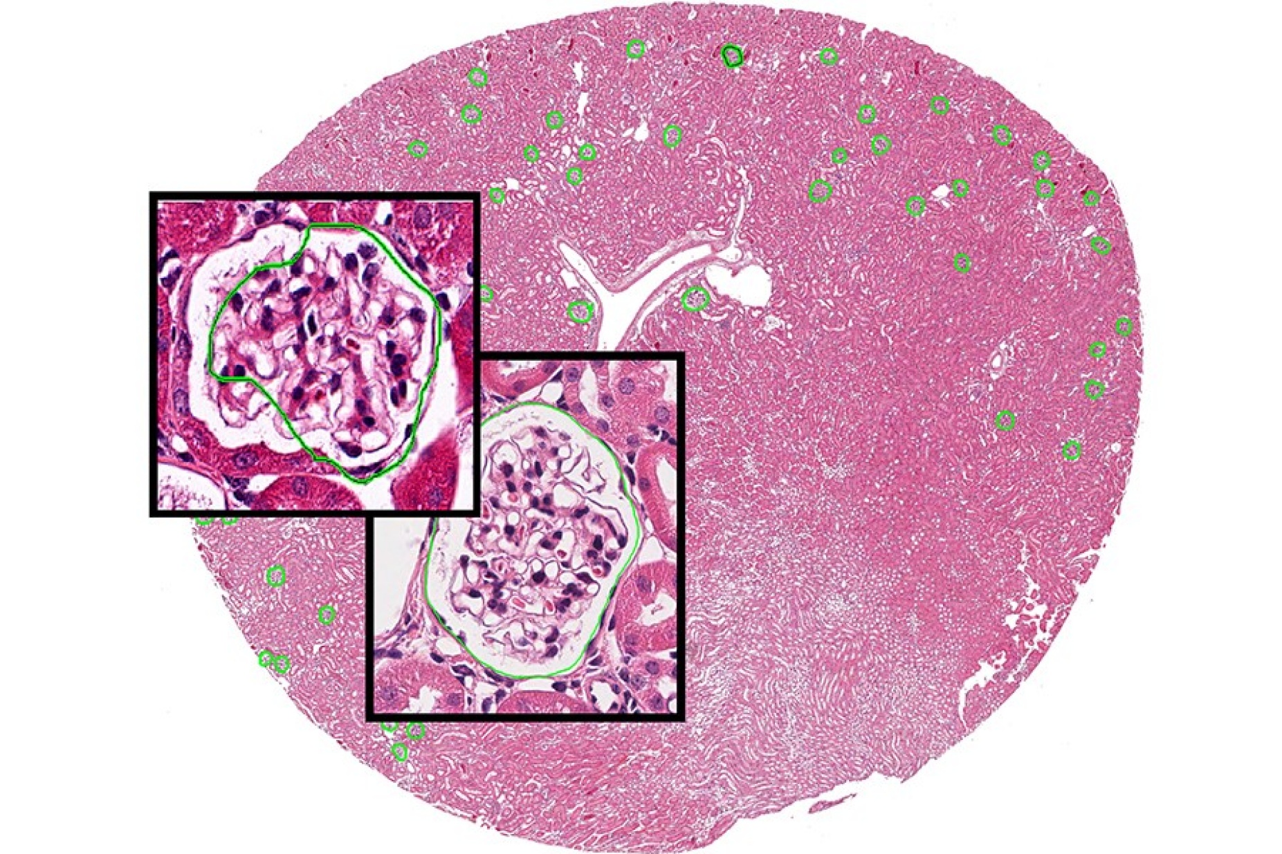 The image shows how the UB tool works, when applied to histology image data. The large background image shows a mouse renal tissue section with kidney structures called glomeruli marked via automatically estimated boundaries. The boundaries can be iteratively updated during system training. The glomeruli structures change when the disease has progressed. 