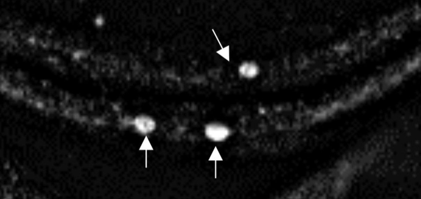 Zoom image: An epifluorescence microscope image shows clumps of human alpha-synuclein aggregating in the neurons of a fruit fly larva. Credit: Anderson, Hirpa, Zheng, Banerjee and Gunawardena, Frontiers in Cellular Neuroscience, Jan. 2020. The image is cropped from a graphic published in the journal article, which is distributed under Creative Commons Attribution License CC BY 4.0 (https://creativecommons.org/licenses/by/4.0/). 
