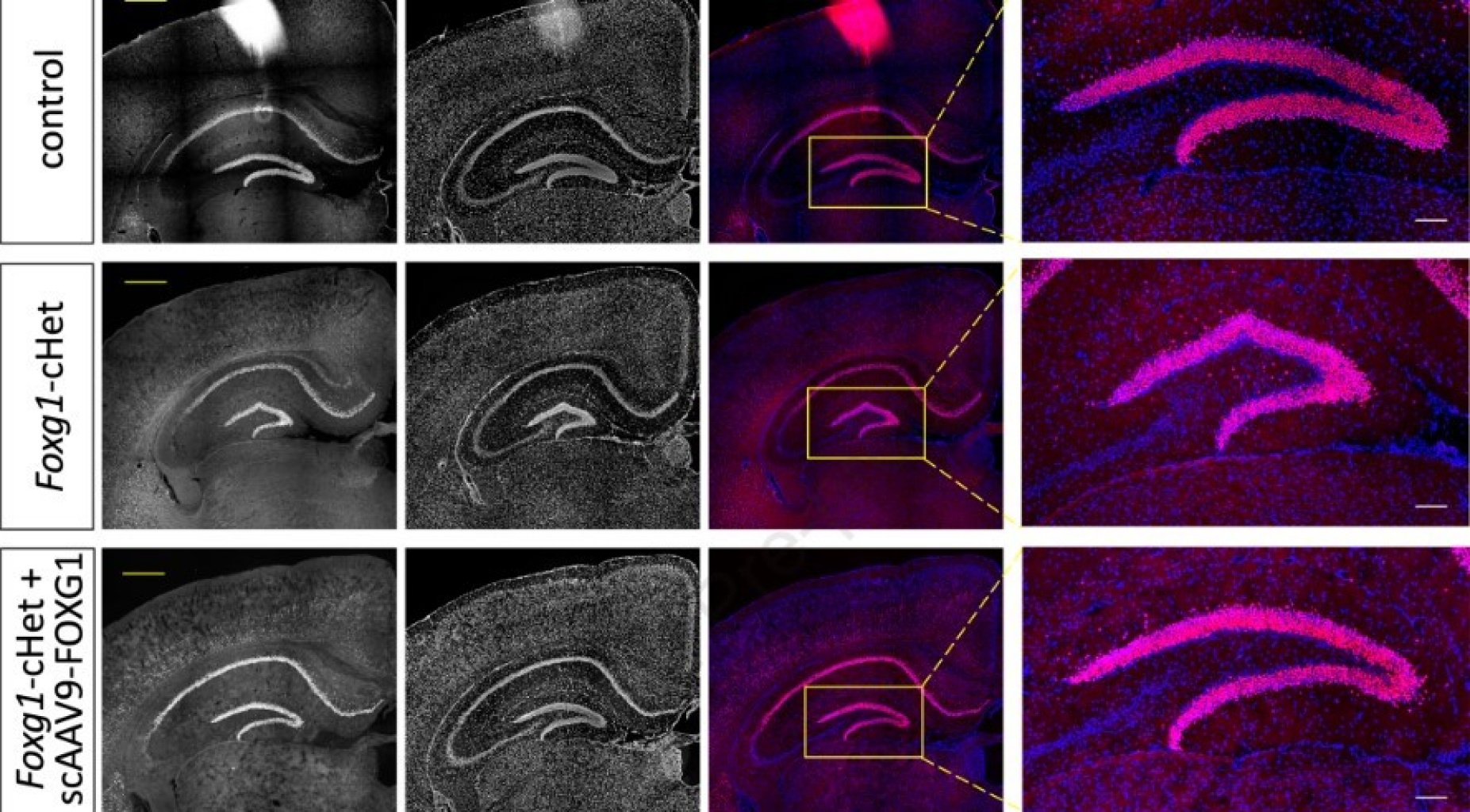 Zoom image: The length and apex angle of the dentate gyrus in a mice with FOXG1 syndrome was restored after a postnatal injection of the researchers' AAV9-based gene therapy. Photo: Soo-Kyung and Jae Lee 