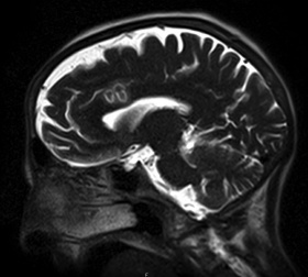 Zoom image: Post-operative MRI. 