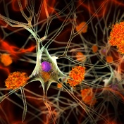 Neurons in Alzheimer's disease. 3D illustration showing amyloid plaques in brain tissue, neurofibrillary tangles and destruction of neuronal networks. 