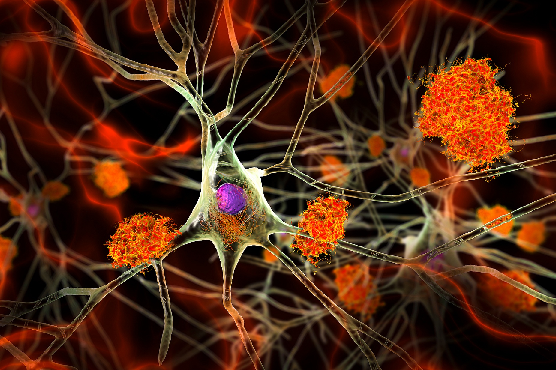 Neurons in Alzheimer's disease. 3D illustration showing amyloid plaques in brain tissue, neurofibrillary tangles and destruction of neuronal networks. 