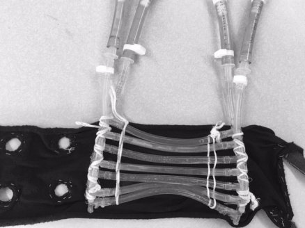 Zoom image: Researchers used a custom-made device, a dual tubing system that was in direct contact with the back of the participants' neck, in the study. One set of tubing was perfused with 93.2 degrees Fahrenheit water. The other series of tubes contained -4 degree liquid, but the flow of this liquid was controlled by a valve. 