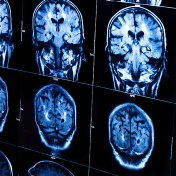 Brain scans. 