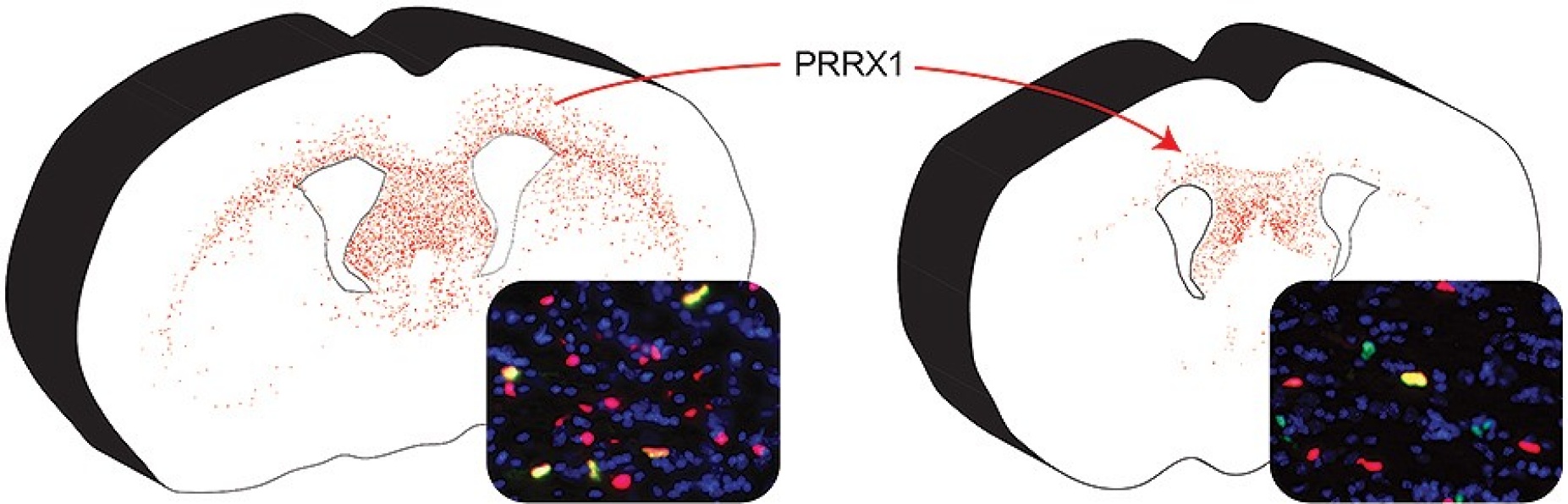 PRRX1 induces pathological quiescence in human oligodendrocyte progenitor cells. Human transplanted oligodendrocyte progenitor cells (shown in red) typically migrate throughout the mouse brain but, following induction of PRRX1, human cells fail to divide and migrate. The insets show individual human cells in red that are undergoing cell division (green color), such that yellow cells represent dividing human cells. PRRX1 prevents cell division and fewer transplanted cells divide. This leads to failed remyelination in the shiverer mouse. 