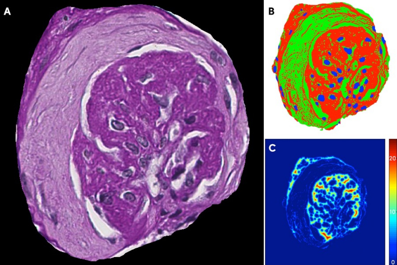 Panel A shows an example image of a non-functioning glomerulus extracted from the biopsy of a diabetes patient. Dark purple regions in the middle indicate scarring due to damage caused by diabetic nephropathy. The white regions are remnants of capillaries that have also been damaged by the disease. These different compartments are detected and displayed with various colors in Panel B. Each compartment is then subject to a series of measurements such as those shown in C, which displays a heatmap of scarring thickness. Thicker regions indicate more extensive scarring. (Credit: Brandon Ginley, University at Buffalo).