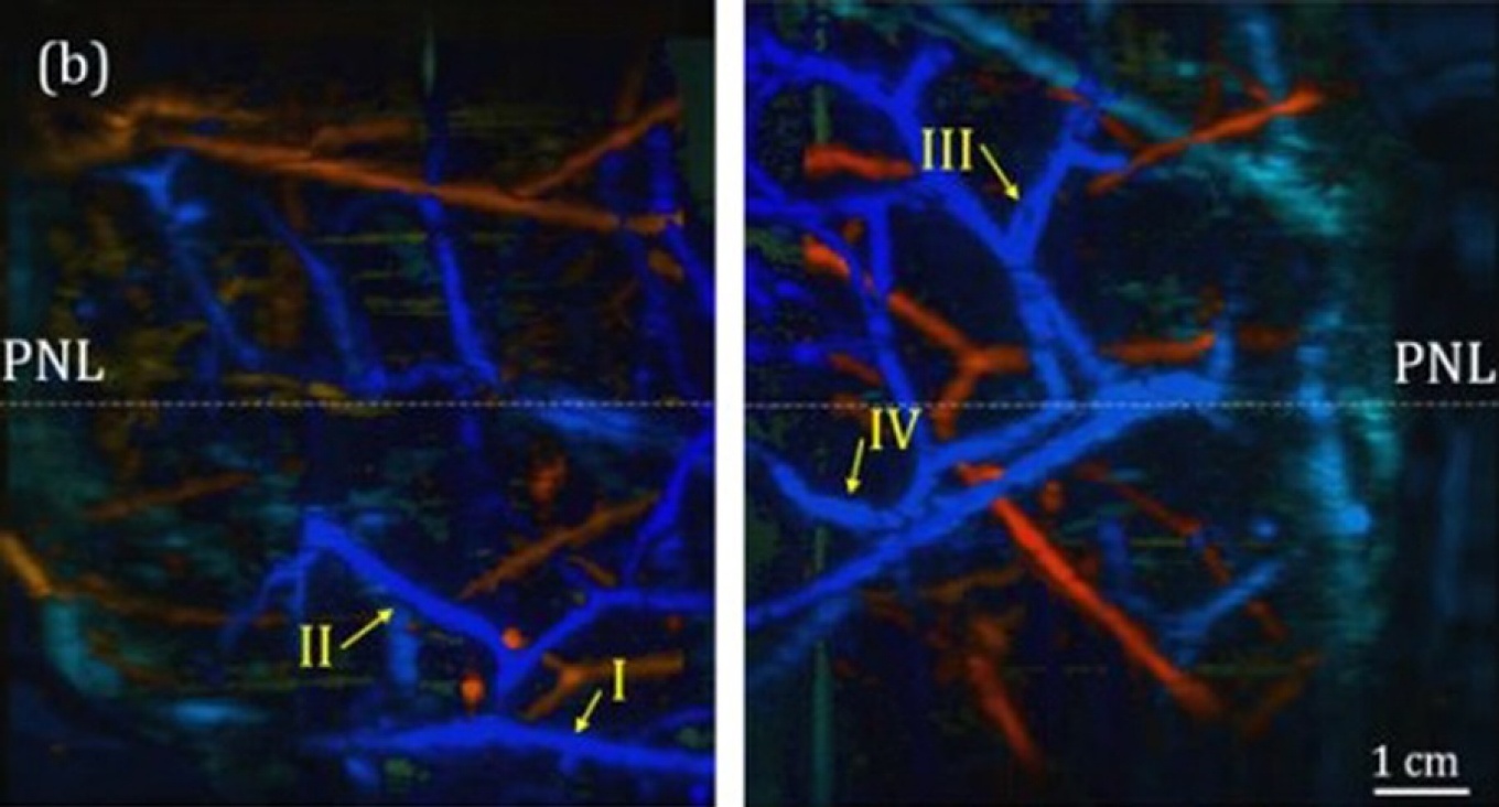 Images showing 3D vasculature of breast tissue acquired by the Dual Scan Mammoscope.