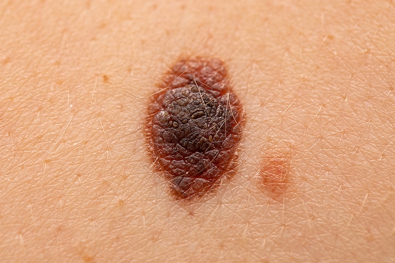 A close up detail of a melanoma. 