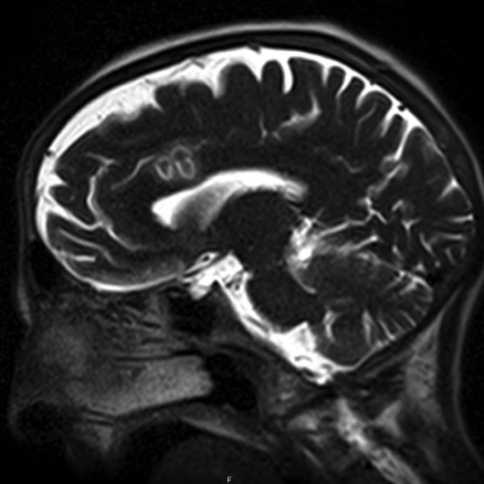 Zoom image: Post-operative MRI 